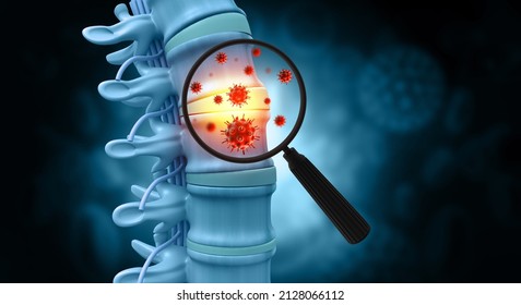 Spine Cancer Or Spinal Tumor Disease.3d Illustration