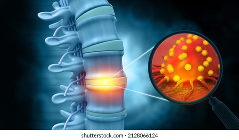 Spine Cancer Or Spinal Tumor Disease.3d Illustration