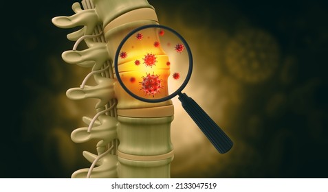 Spine Cancer Or Spinal Tumor Disease.3d Illustration