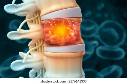 Spine Cancer Or Spinal Tumor Disease.3d Illustration