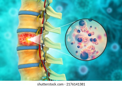 Spine Cancer Or Spinal Tumor Disease.3d Illustration