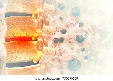 Spine Cancer Or Spinal Tumor Disease.3d Illustration