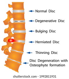 Spine Conditions. Degenerative Disc. Herniated Disc. Thinning Disc. Disc Degeneration With Osteophyte Formation