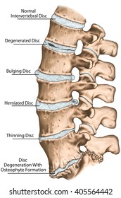 Spine disc problems, degenerative lumbar disc disease, degenerative disc disorder, degenerated disk, bulging disk, herniated disk, thinning disk, disk degeneration with osteophyte formation