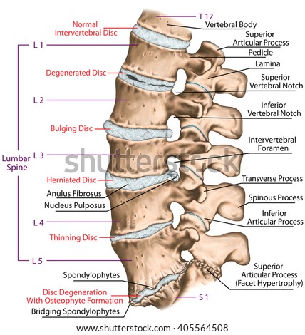 Spine disc problems, degenerative lumbar disc disease, degenerative disc disorder, degenerated disk, bulging disk, herniated disk, thinning disk, disk degeneration with osteophyte formation Stock photo © 