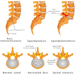 Spine Fracture. Spondylolysis (Spondylolisthesis) Is A Defect In The Bony Ring Comprising The Spinal Column. Displacement Of A Lumbar Vertebra, Most Commonly Occurring After A Break Or Fracture.