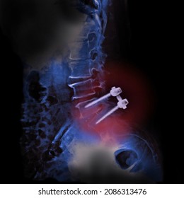 Spine Fusion Surgery Of Human