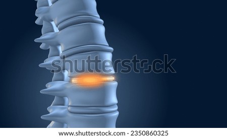 The Spine is Stabilized with Lumbar Implants 3D illustration