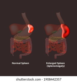Splenomegaly Spleen Enlargement Spleen Illustration On Stock ...