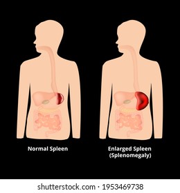 enlarged spleen in kids