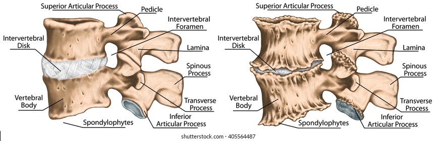 uncovertebral arthrosis articulatia femuro tibiala