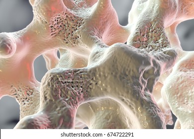 Spongy Bone Tissue Affected By Osteoporosis, 3D Illustration