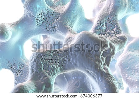 Spongy Bone Tissue Affected By Osteoporosis Stock Illustration