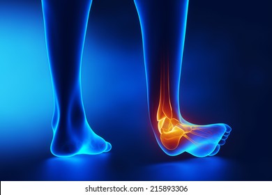 Sprained Ankle Blue X-ray