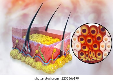 Spreading of cancer cell in human skin layer, Skin cancer, Medical diagram. 3d illustration - Powered by Shutterstock