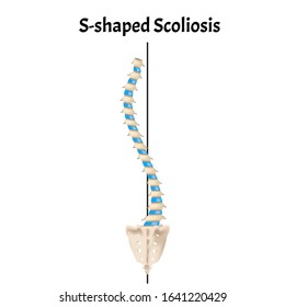 Levoscoliosis Images, Stock Photos & Vectors | Shutterstock