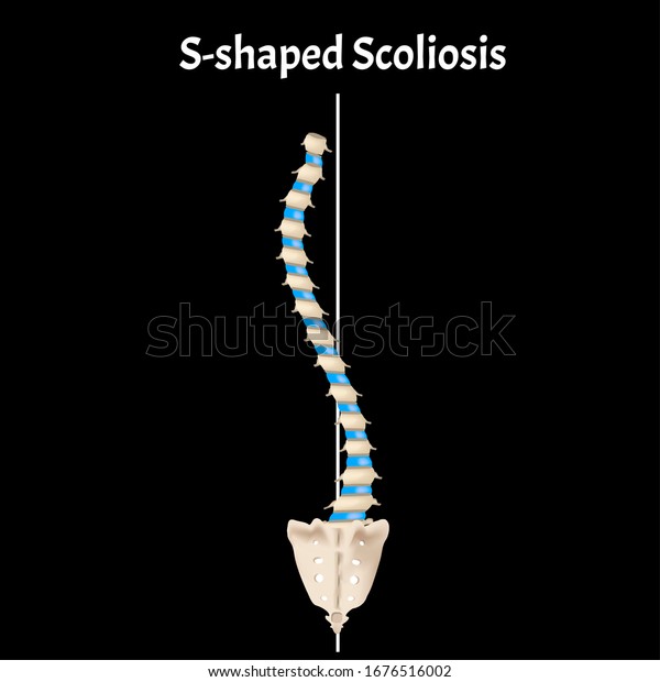 Sshaped Scoliosis Dextroscoliosis Levoscoliosis Spinal Curvature Stock ...