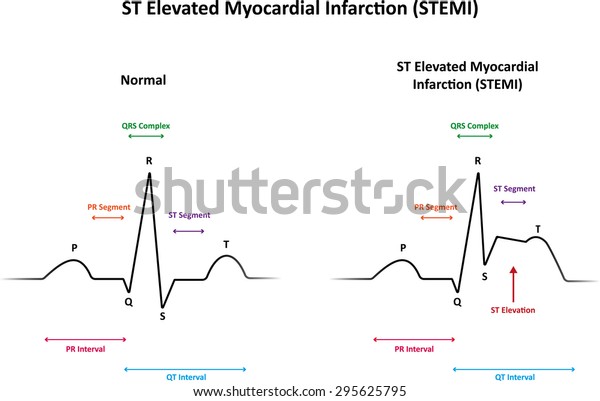 St Elevated Myocardial Infarction Stemi Stock Illustration 295625795