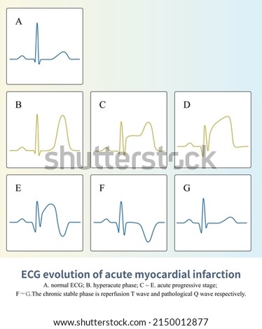 In ST segment elevation myocardial infarction, the ST-T of ECG will undergo a characteristic evolution process, and finally appear pathological Q wave, sometimes lasting for a lifetime.