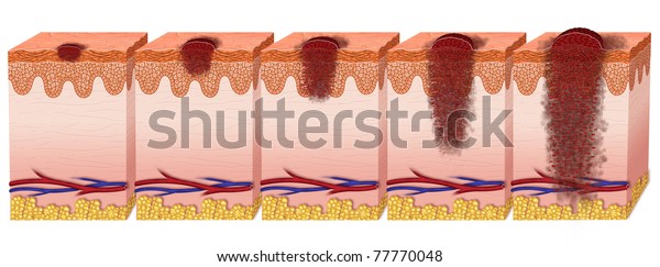 Stadiums Melanoma Stock Illustration 77770048