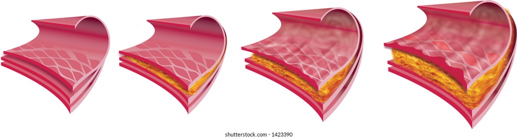 Stages Of Cardiovascular Disease (atherosclerosis), High Resolution JPEG