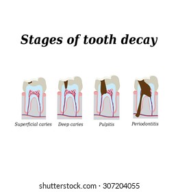 313 Periodontal disease stages Images, Stock Photos & Vectors ...