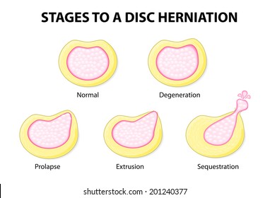 stages to a disc herniation. Normal, Degeneration, Prolapse, Extrusion, Sequestration