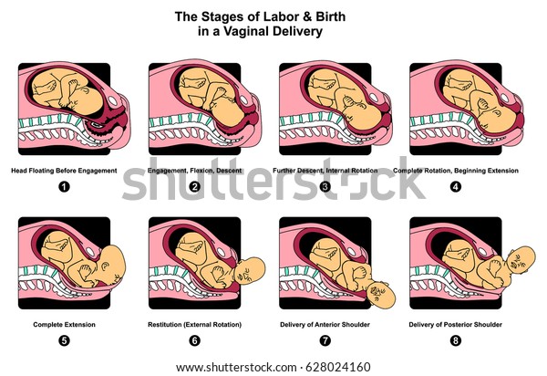 医療科学教育と医療のための婚約降下の内部完全回転延長ポスターを含む 膣内での分娩と出産の段階のインフォグラフィック図 のイラスト素材 628024160