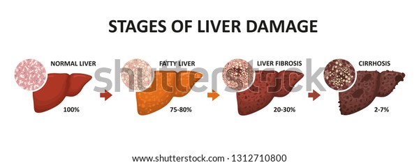 Stages Liver Damage Healthy Fatty Liver Stock Illustration 1312710800