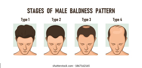 Male Pattern Hair Loss High Res Stock Images Shutterstock