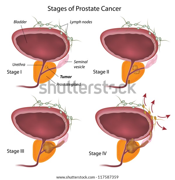 Prostate cancer abdominal lymph nodes