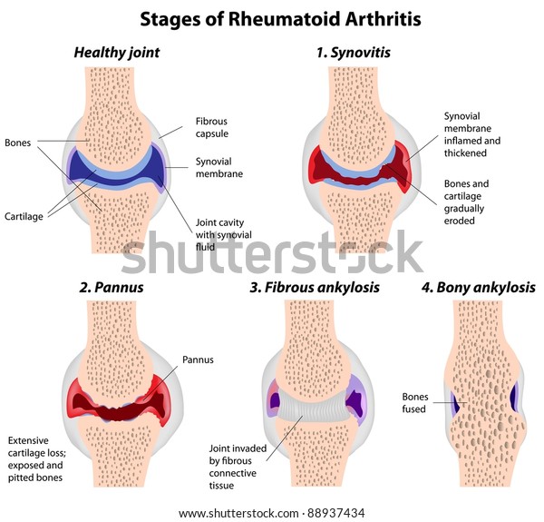 korai stádiumú rheumatoid arthritis)