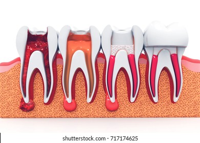 Stages Of Root Canal Treatment.3d Render