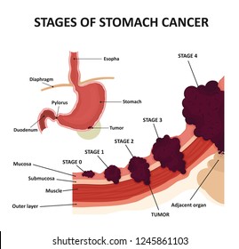 Stages Of Stomach Cancer. Classification Of Malignant Tumours.