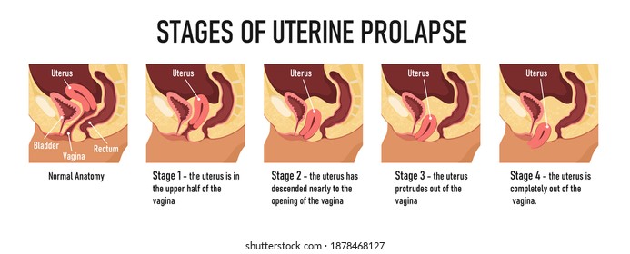 Stages Of Uterine Prolapse. Ьedical Poster