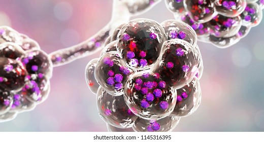 Staphylococcal Pneumonia Medical Concept 3d Illustration Stock ...