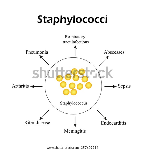 Staphylococci Staphylococcus Aureus Causes Diseases Infographics 스톡