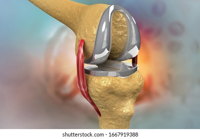 Steel Knee Cap On Knee Joint. 3d Illustration	