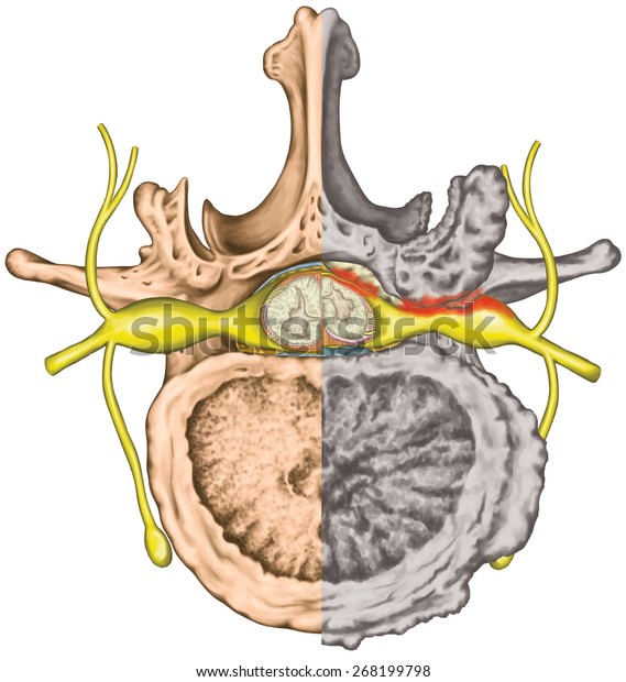 Stenosis Central Lateral Stenosis Nervous System Stock Illustration ...