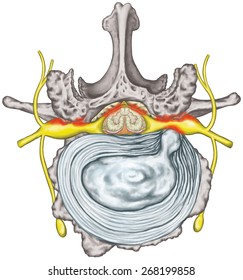 235 Herniated Nucleus Pulposus Images, Stock Photos & Vectors 