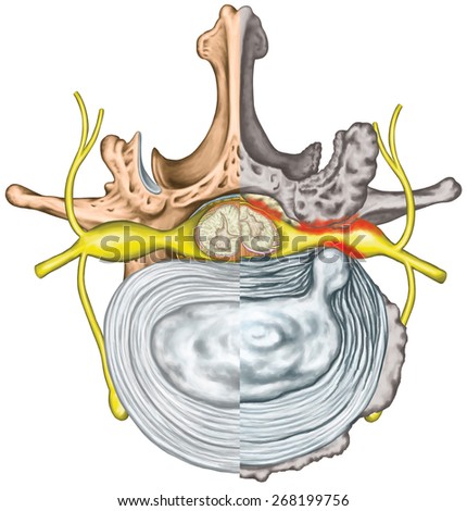 Stenosis, lumbar disk herniation, herniated disc, lumbar vertebra, osteophytes, spondylophytes,  nervous system, nerve root, spinal cord, arthrosis,  anatomy of human skeletal and nervous system