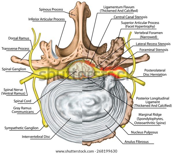 Lumbar Disc Herniation Nerve Root