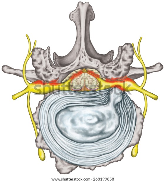 Stenosis Lumbar Disk Herniation Herniated Disc Stock Illustration 