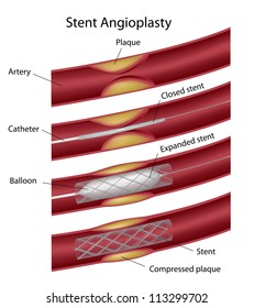 Stent Angioplasty