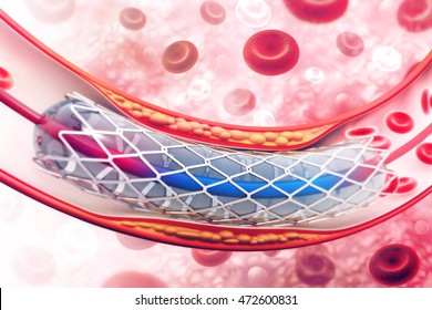 Stent angioplasty. 3d illustration

