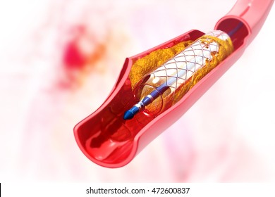 Stent angioplasty. 3d illustration


