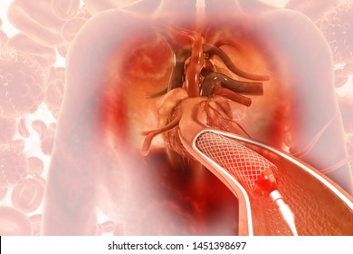 Stent angioplasty on scientific background. 3d illustration
