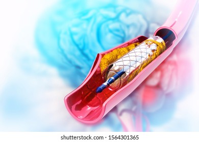Stent angioplasty on scientific background. 3d illustration