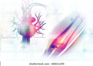 Stent angioplasty procedure with placing a balloon