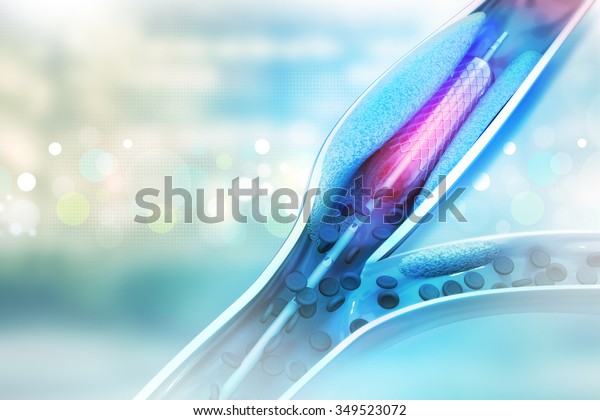 Stent Angioplasty Procedure Placing Balloon Stock Illustration 349523072